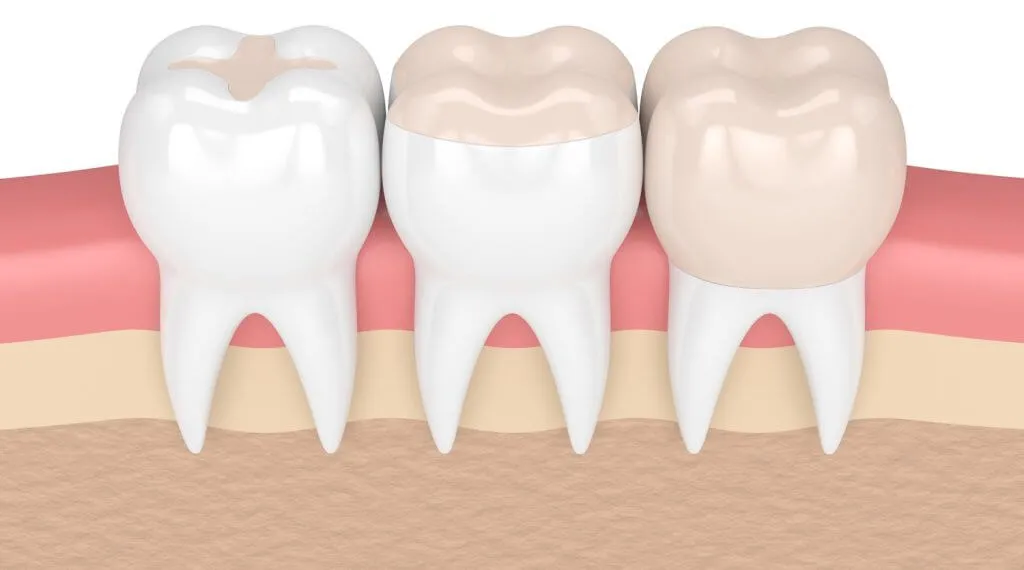 Render of three molars showing a filling, an inlay and a crown