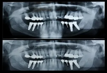 Una radiografía panorámica dental que muestra una dentadura completa